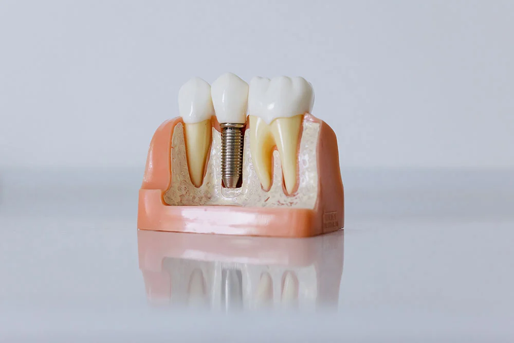 teeth implant dental 